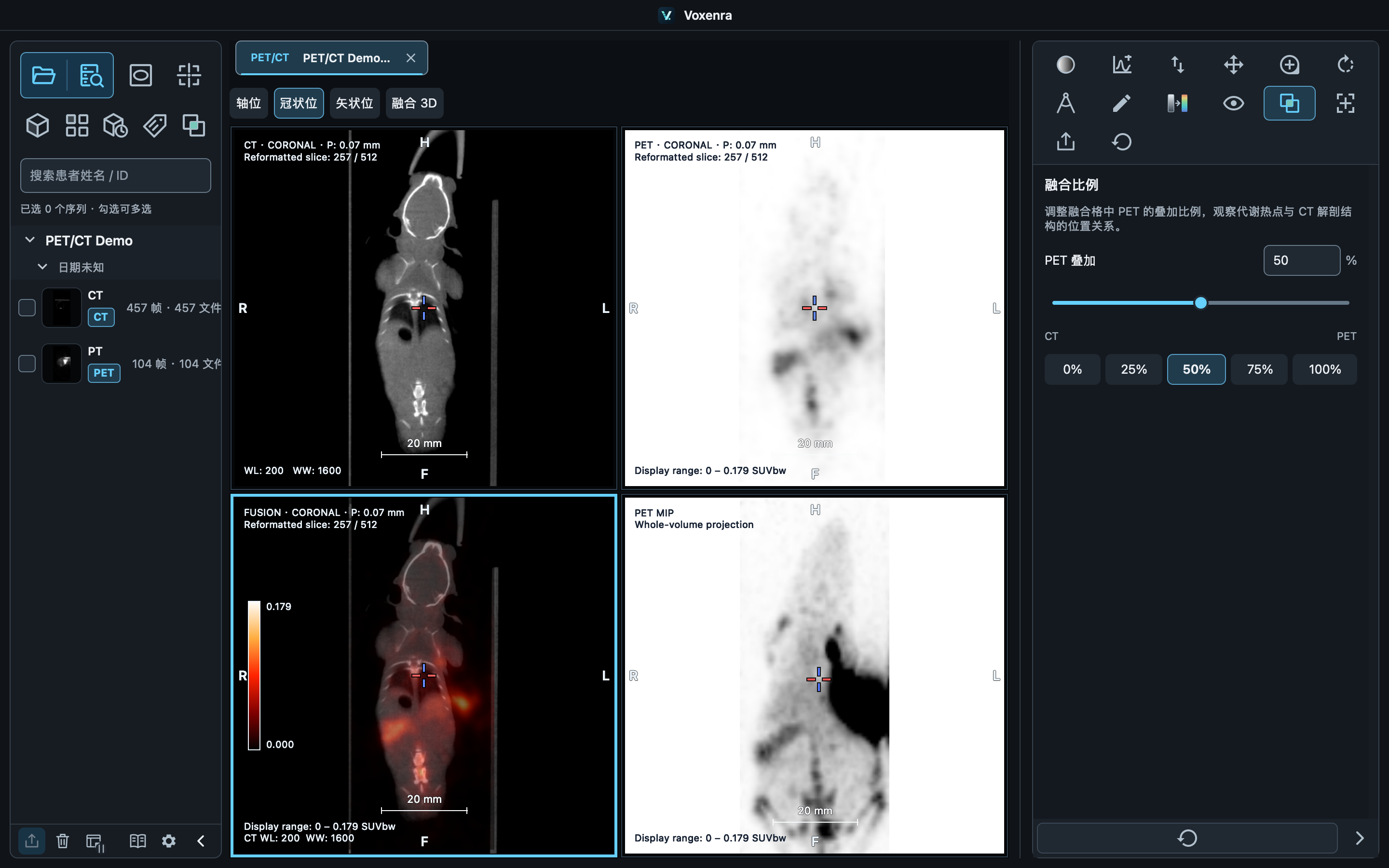 Voxenra 中的 CT、PET 与融合视图